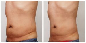 before & after image of skin tightening treatment of a man