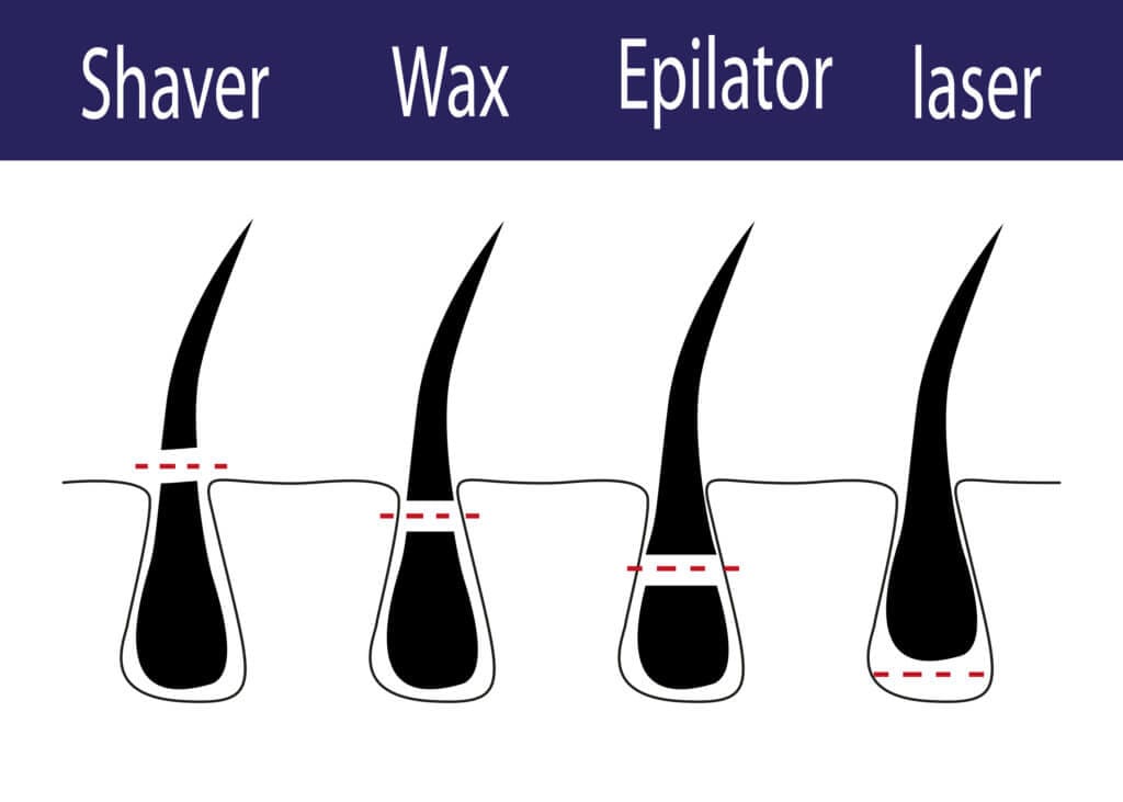 Laser Hair Removal Timeline What can you expect? HC MedSpa