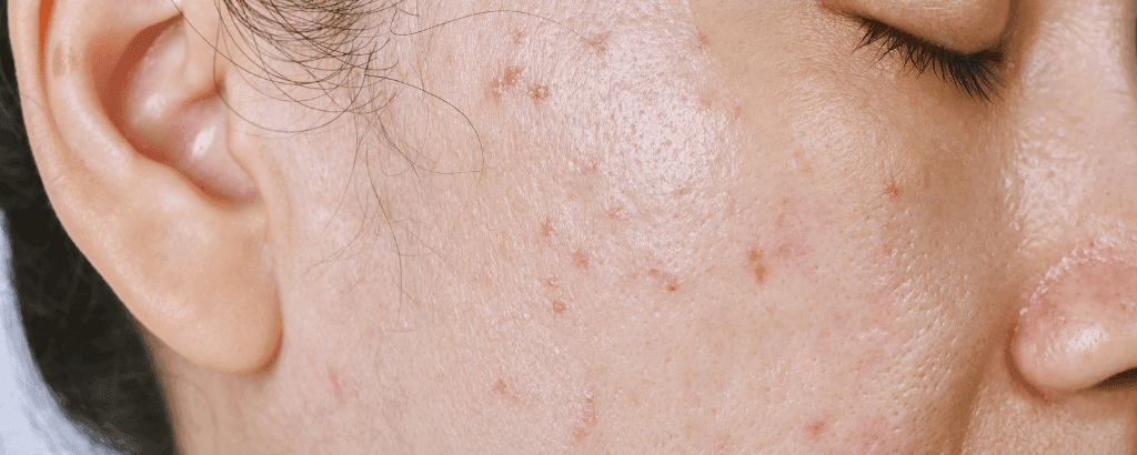 oily acne prone skin