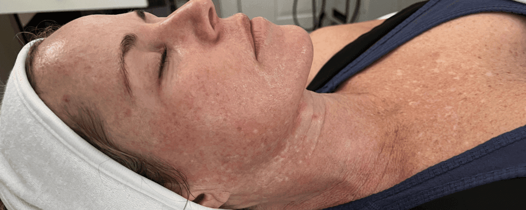 skin pigmentation and sun damage